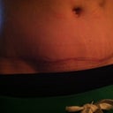 The scar