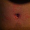 Belly button healing (I hope)