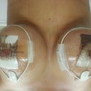 Thoughts? Hopefully bandages removed tomorrow.