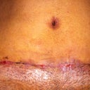 Pic of Scarr and BB at two weeks post op (You can see in the center the two areas that split. That is where I am draining from. The area to the left as you are looking at the pic was where the drain was) BB is doing way better.