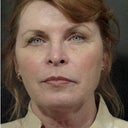 Before Sculptra (and Dysport / Juvederm)