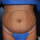 Front shot before surgery