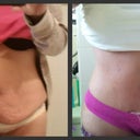 Before and after. 3 days PO, my first peek under the binder. I had the drains removed 3 days later.