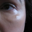 19 months after Sculptra - Before first subscision