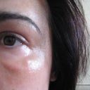 7 months after Sculptra