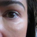 21 months after Sculptra - After second subscision