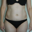 Pre-op (front)