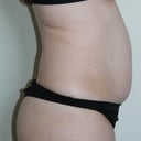 Pre-op (right)