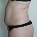 Pre-op (left)