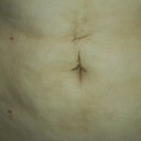 2 1/2 weeks (crease and incisions)