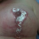 burst areola with cream on 6 weeks post op