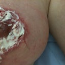 burst areola