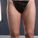 Front thighs ~5.5 months post procedure
