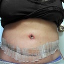 10 days PO. The belly button is looking a tad scary!