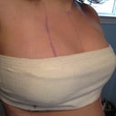 one day post op