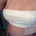 one day post op
