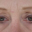 Before surgery mudflap eyelids