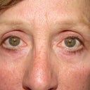 With no makeup after surgery