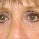 4 months after surgery with makeup