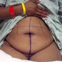 9/19 day of surgery before pic