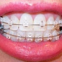 11-12 week follow-up visit.  Lots of tooth spacing.   2nd ortho visit.