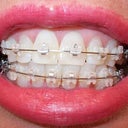 11-12 week follow-up visit.  Lot's of tooth spacing.  2nd Ortho visit.