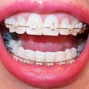 11-12 week follow-up visit.  Lot's of tooth spacing.  2nd Ortho visit.