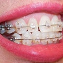 11-12 week follow-up visit.  Unsightly spacing, necessary to move teeth later.