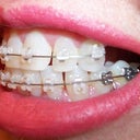 11-12 week follow-up visit.  Unsightly spacing, necessary to move teeth later.