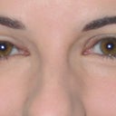 Day 7 Uneven Swelling