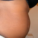 side view before procedure