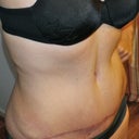 Can see a tiny bit of definition above my almost hidden BB...still swollen.