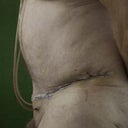 side view 4 days post op