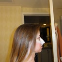 Side View, 18 hours postop.