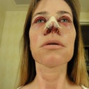 I know this is a gross pic, but this is surgery for ya! 24 hours postop.  Packing still in, still a bit bloody. I had to have a drip pad across my nose for 2 days because the entire first 24 hours I bled constantly. I also had upper blepharoplasty to deal with 2 old injuries and the droop they were causing. Still might have to go for levator repair in the future.