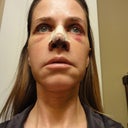 Lower view, 3 days postop.  Yuck!