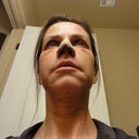 4 days postop.  The swelling was starting to get REALLY bad. Day 5 I couldn't really open my mouth, let alone smile.  :(