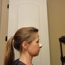 Day 4 postop side view.