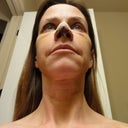 Lower view 1 week postop. Bruises are fading!  At one point I was bruised eyebrows to collarbone.