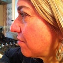 Treatment 2-post Fraxel 7 days, no foundation only eyes