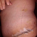 7 days post op