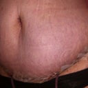 7 days post op still swollen