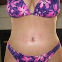 16 days post op checking to make sure bikini would cover the scar.