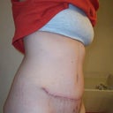 Day 26 Post Op