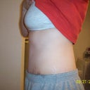 Day 26 Post Op