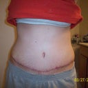 Day 26 Post Op
