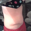 3 weeks po. a little upper ab swelling.