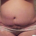Week 10 scar. Swelling decreased on the left side. Pic taken at night and the rest of my tummy is very swollen.