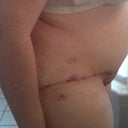 Post op  Day 8 side view 063012