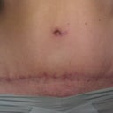 Scar at 46 days P.O.  Roughly 6.5 weeks.  Doesn't look quite as good as a lot of the others on here, but that's just how I heal, lol.